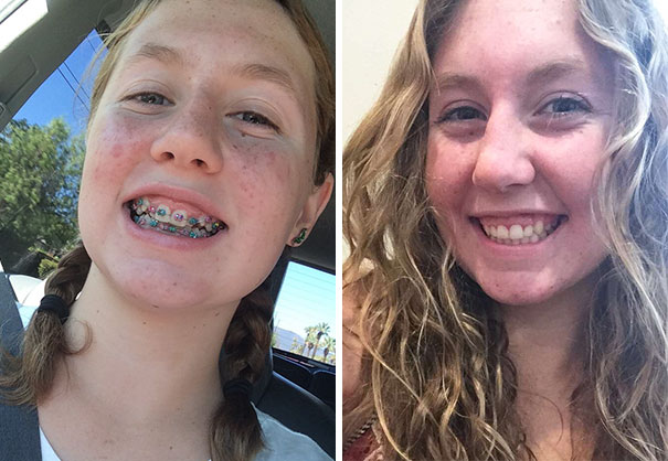 Illustration de l'article : 115 photos avant/après qui prouvent l’efficacité des appareils dentaires 