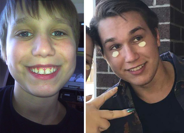 Illustration de l'article : 115 photos avant/après qui prouvent l’efficacité des appareils dentaires 