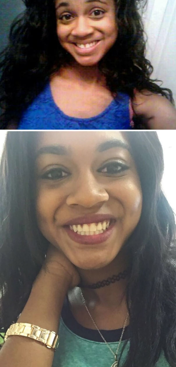 Illustration de l'article : 115 photos avant/après qui prouvent l’efficacité des appareils dentaires 