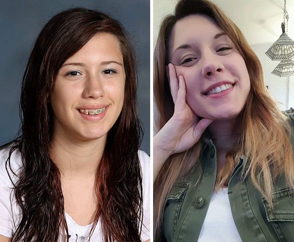 Illustration de l'article : 115 photos avant/après qui prouvent l’efficacité des appareils dentaires 