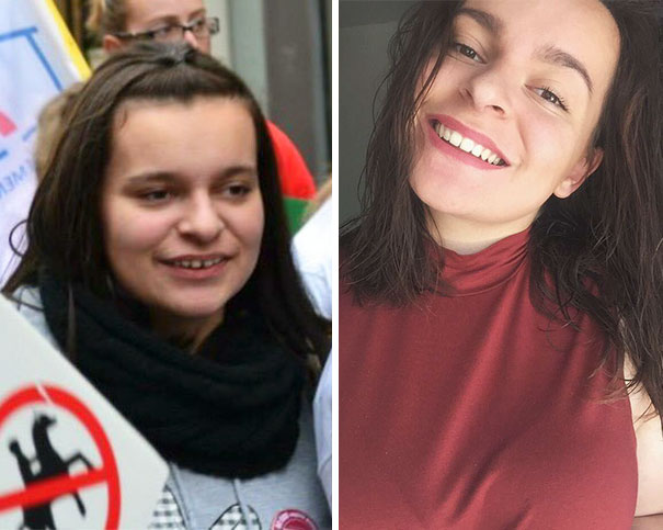 Illustration de l'article : 115 photos avant/après qui prouvent l’efficacité des appareils dentaires 