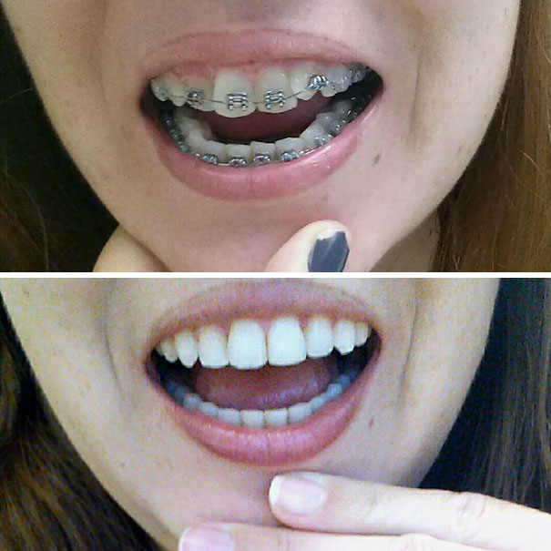 Illustration de l'article : 115 photos avant/après qui prouvent l’efficacité des appareils dentaires 