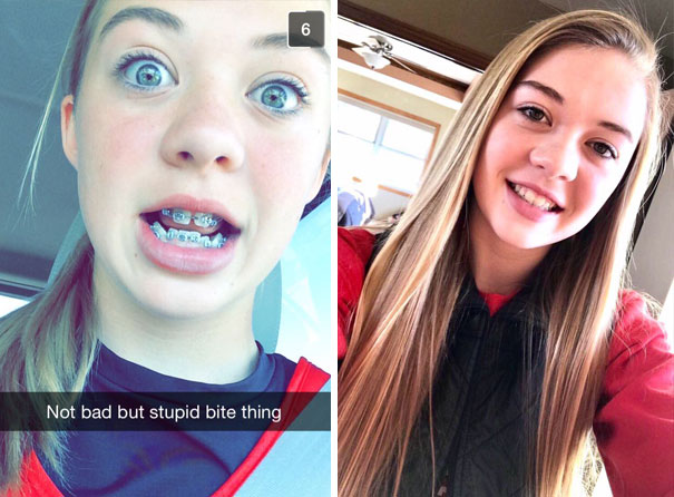 Illustration de l'article : 115 photos avant/après qui prouvent l’efficacité des appareils dentaires 