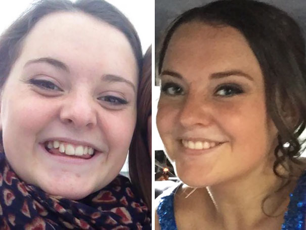 Illustration de l'article : 115 photos avant/après qui prouvent l’efficacité des appareils dentaires 