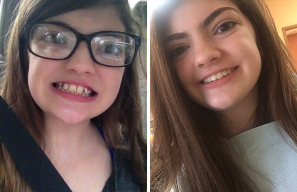 Illustration de l'article : 115 photos avant/après qui prouvent l’efficacité des appareils dentaires 