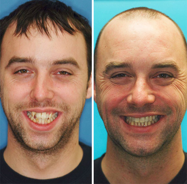 Illustration de l'article : 115 photos avant/après qui prouvent l’efficacité des appareils dentaires 