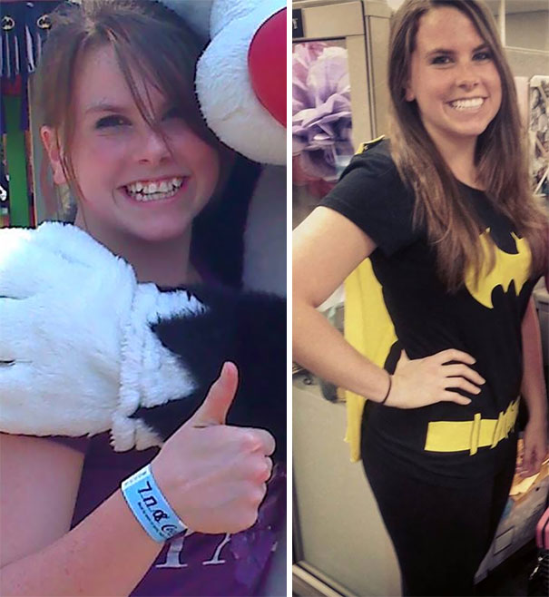 Illustration de l'article : 115 photos avant/après qui prouvent l’efficacité des appareils dentaires 