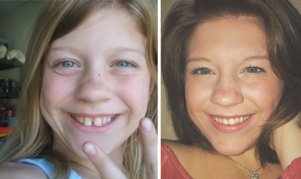 Illustration de l'article : 115 photos avant/après qui prouvent l’efficacité des appareils dentaires 