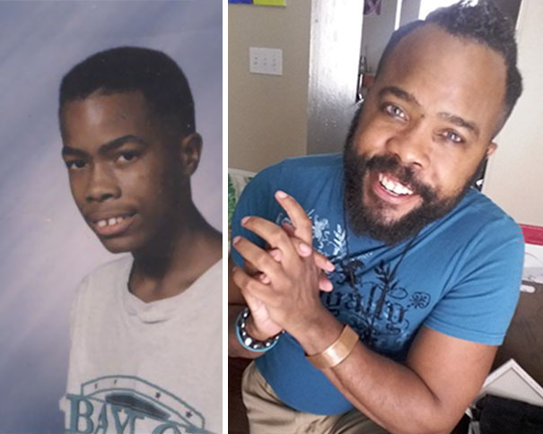 Illustration de l'article : 115 photos avant/après qui prouvent l’efficacité des appareils dentaires 