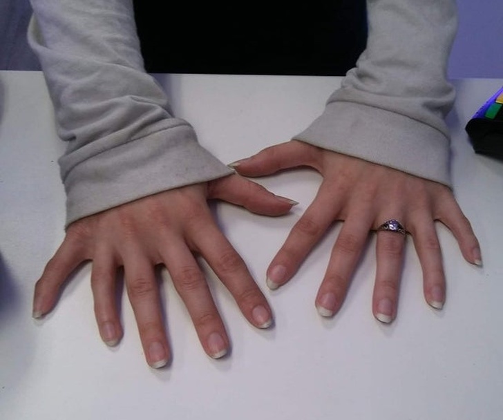 Illustration de l'article : Ces 15 personnes nées avec des signes distinctifs