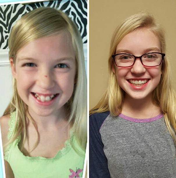 Illustration de l'article : 115 photos avant/après qui prouvent l’efficacité des appareils dentaires 