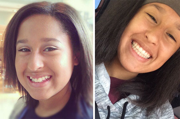 Illustration de l'article : 115 photos avant/après qui prouvent l’efficacité des appareils dentaires 