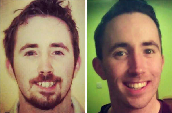 Illustration de l'article : 115 photos avant/après qui prouvent l’efficacité des appareils dentaires 