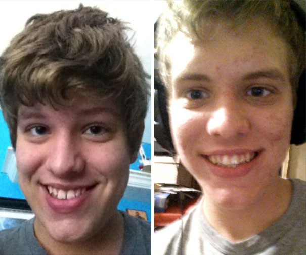 Illustration de l'article : 115 photos avant/après qui prouvent l’efficacité des appareils dentaires 