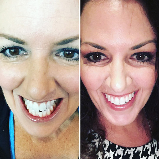 Illustration de l'article : 115 photos avant/après qui prouvent l’efficacité des appareils dentaires 