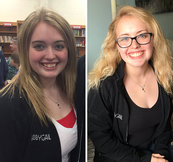 Illustration de l'article : 115 photos avant/après qui prouvent l’efficacité des appareils dentaires 