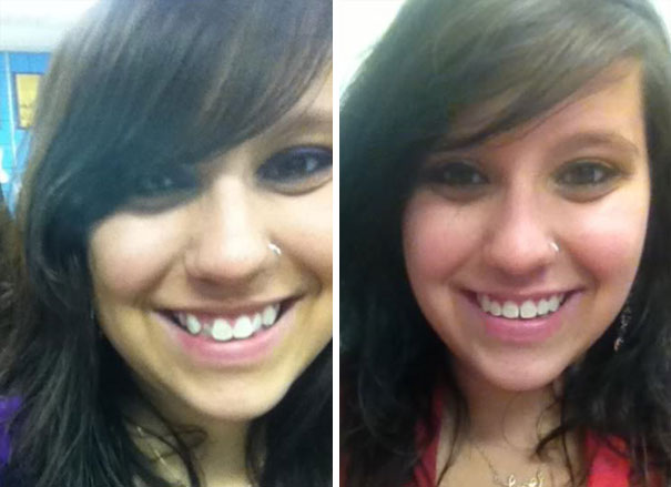 Illustration de l'article : 115 photos avant/après qui prouvent l’efficacité des appareils dentaires 