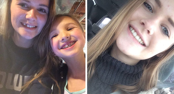 Illustration de l'article : 115 photos avant/après qui prouvent l’efficacité des appareils dentaires 