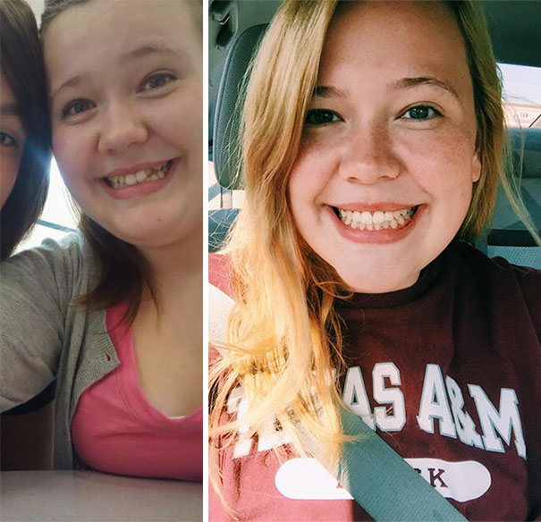 Illustration de l'article : 115 photos avant/après qui prouvent l’efficacité des appareils dentaires 