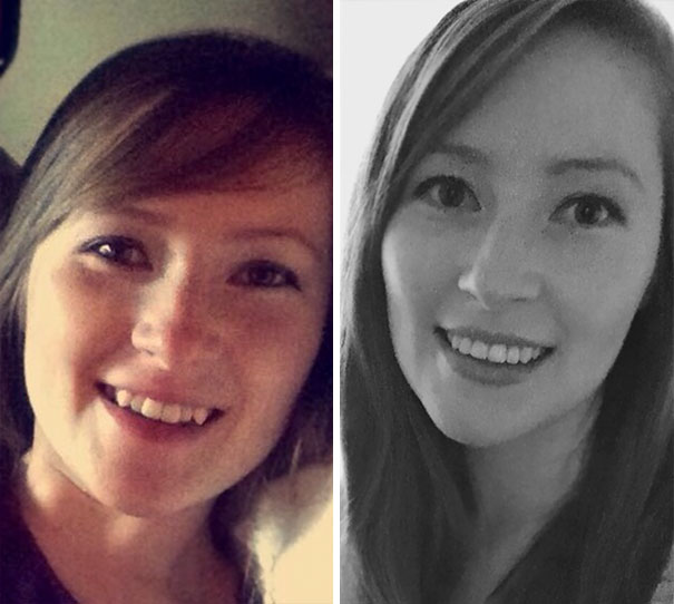 Illustration de l'article : 115 photos avant/après qui prouvent l’efficacité des appareils dentaires 