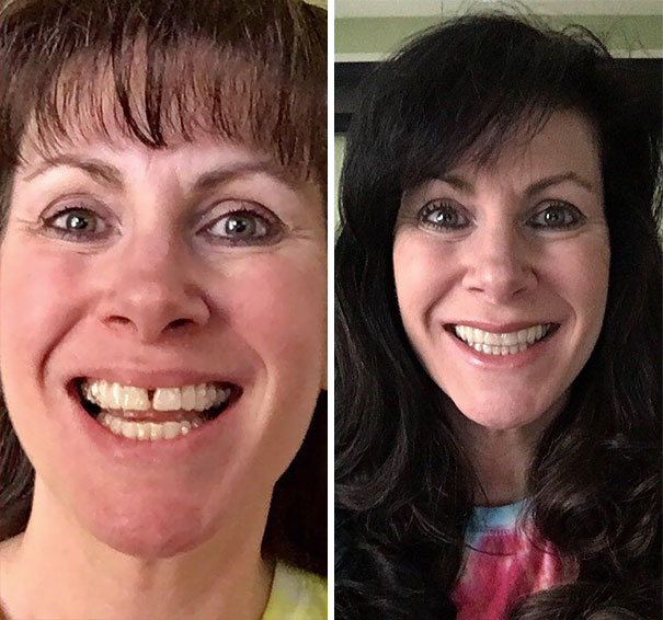 Illustration de l'article : 115 photos avant/après qui prouvent l’efficacité des appareils dentaires 