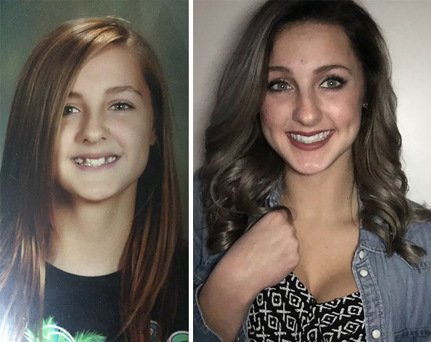 Illustration de l'article : 115 photos avant/après qui prouvent l’efficacité des appareils dentaires 