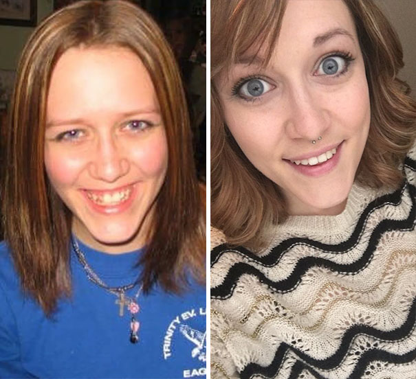 Illustration de l'article : 115 photos avant/après qui prouvent l’efficacité des appareils dentaires 