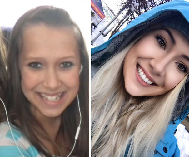 Illustration de l'article : 115 photos avant/après qui prouvent l’efficacité des appareils dentaires 