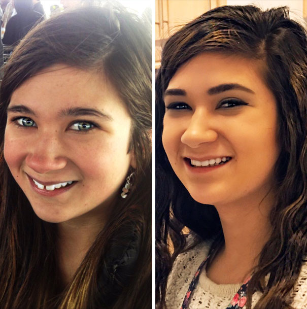 Illustration de l'article : 115 photos avant/après qui prouvent l’efficacité des appareils dentaires 