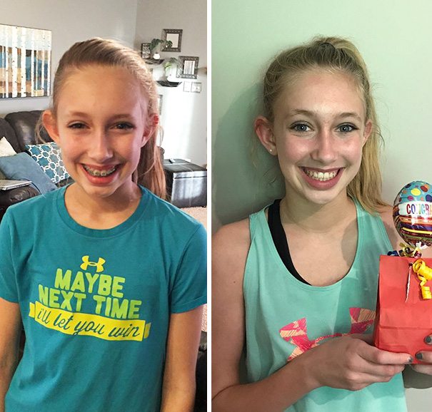 Illustration de l'article : 115 photos avant/après qui prouvent l’efficacité des appareils dentaires 