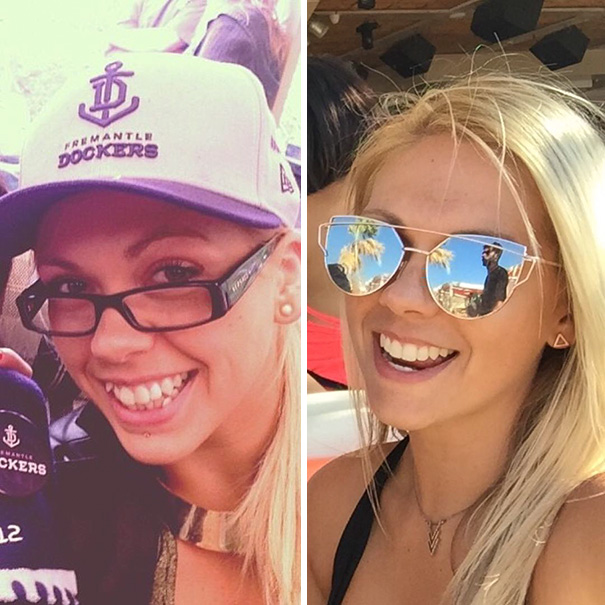 Illustration de l'article : 115 photos avant/après qui prouvent l’efficacité des appareils dentaires 