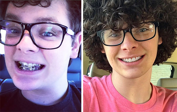 Illustration de l'article : 115 photos avant/après qui prouvent l’efficacité des appareils dentaires 