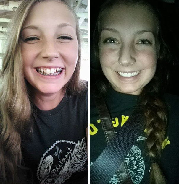 Illustration de l'article : 115 photos avant/après qui prouvent l’efficacité des appareils dentaires 