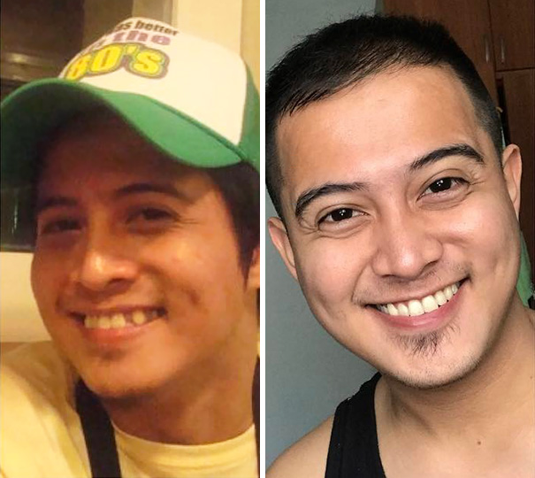 Illustration de l'article : 115 photos avant/après qui prouvent l’efficacité des appareils dentaires 