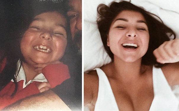 Illustration de l'article : 115 photos avant/après qui prouvent l’efficacité des appareils dentaires 