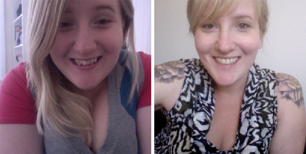 Illustration de l'article : 115 photos avant/après qui prouvent l’efficacité des appareils dentaires 