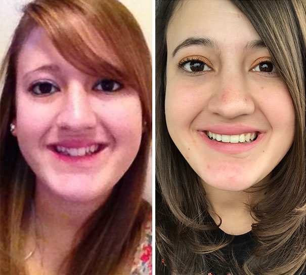 Illustration de l'article : 115 photos avant/après qui prouvent l’efficacité des appareils dentaires 