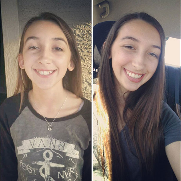 Illustration de l'article : 115 photos avant/après qui prouvent l’efficacité des appareils dentaires 