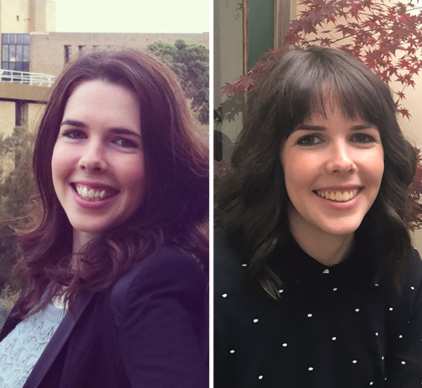 Illustration de l'article : 115 photos avant/après qui prouvent l’efficacité des appareils dentaires 